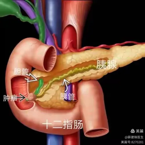 一句话科普黄疸(15)壶腹部周围肿瘤
